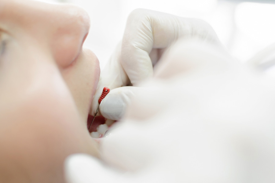 Terapia conservativa ed endodonzia